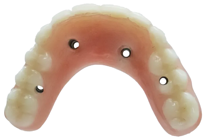 Traditional implants with visible screw holes