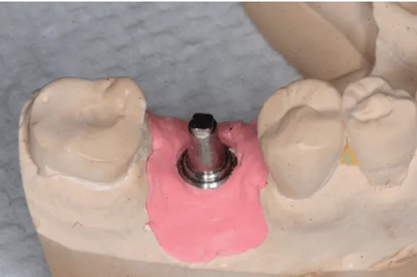 Figure 8. Definitive cast with abutment analog in place.