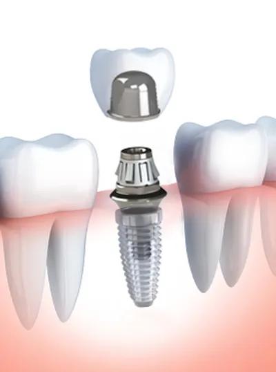 Smileloc Dental Implant Centers All-on-4 Digital Workflow