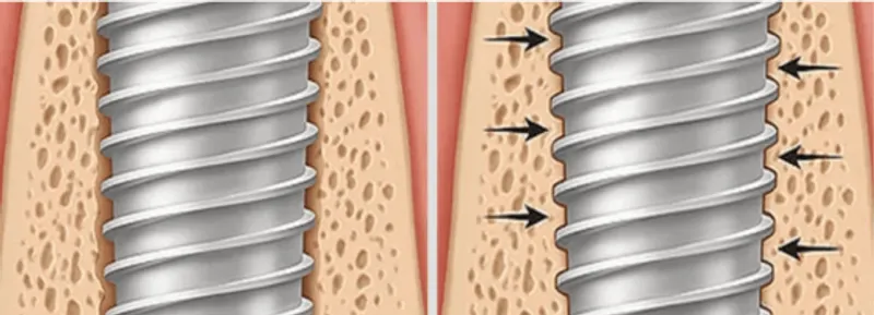 Dental implant showing bone integration