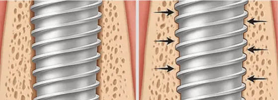 How Dental Implants Bond with Bone