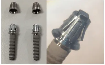 Assessment of Nickel Ion Release from Smileloc® Sleeves