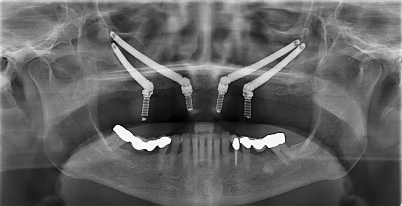 Xray of dental implants in jaw