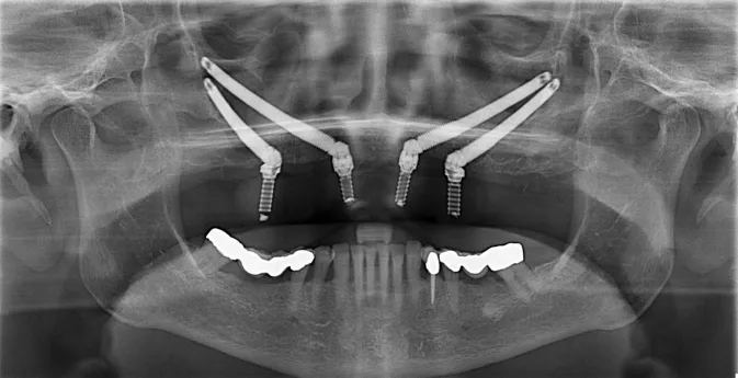 Do I Need a Sinus Lift or Zygomatic Implant?