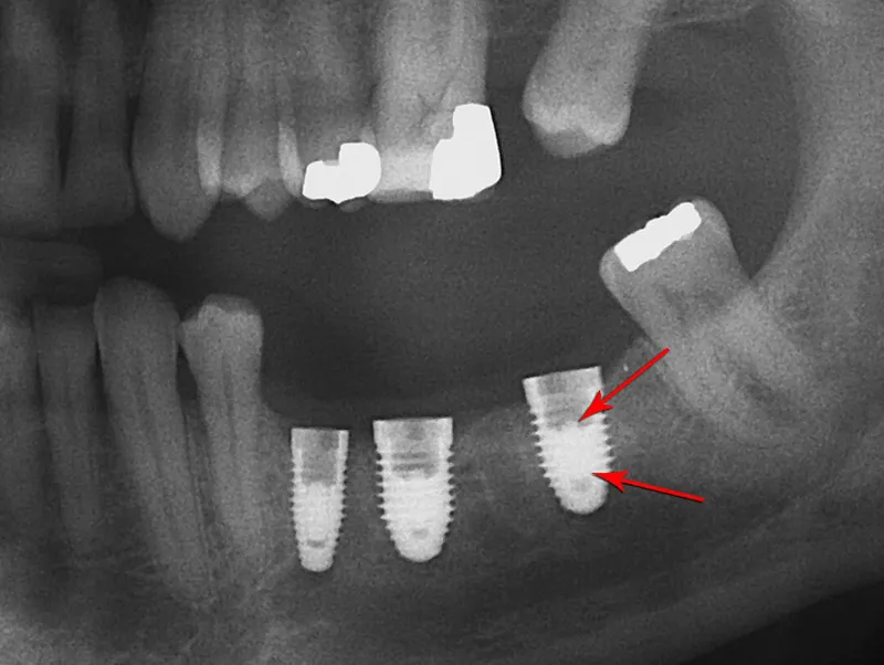 Screw in teeth in a patients jaw
