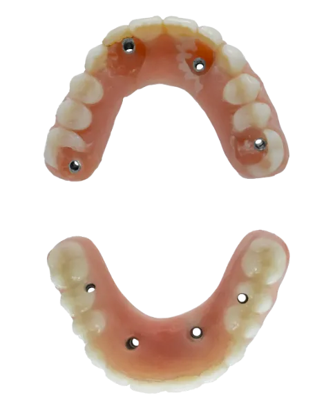 Dental implant prosthesis with visible screw holes and retention screws
