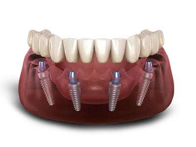What Do Dental Implants Feel Like?