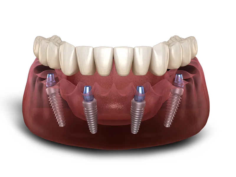 Patient smiling confidently with dental implants
