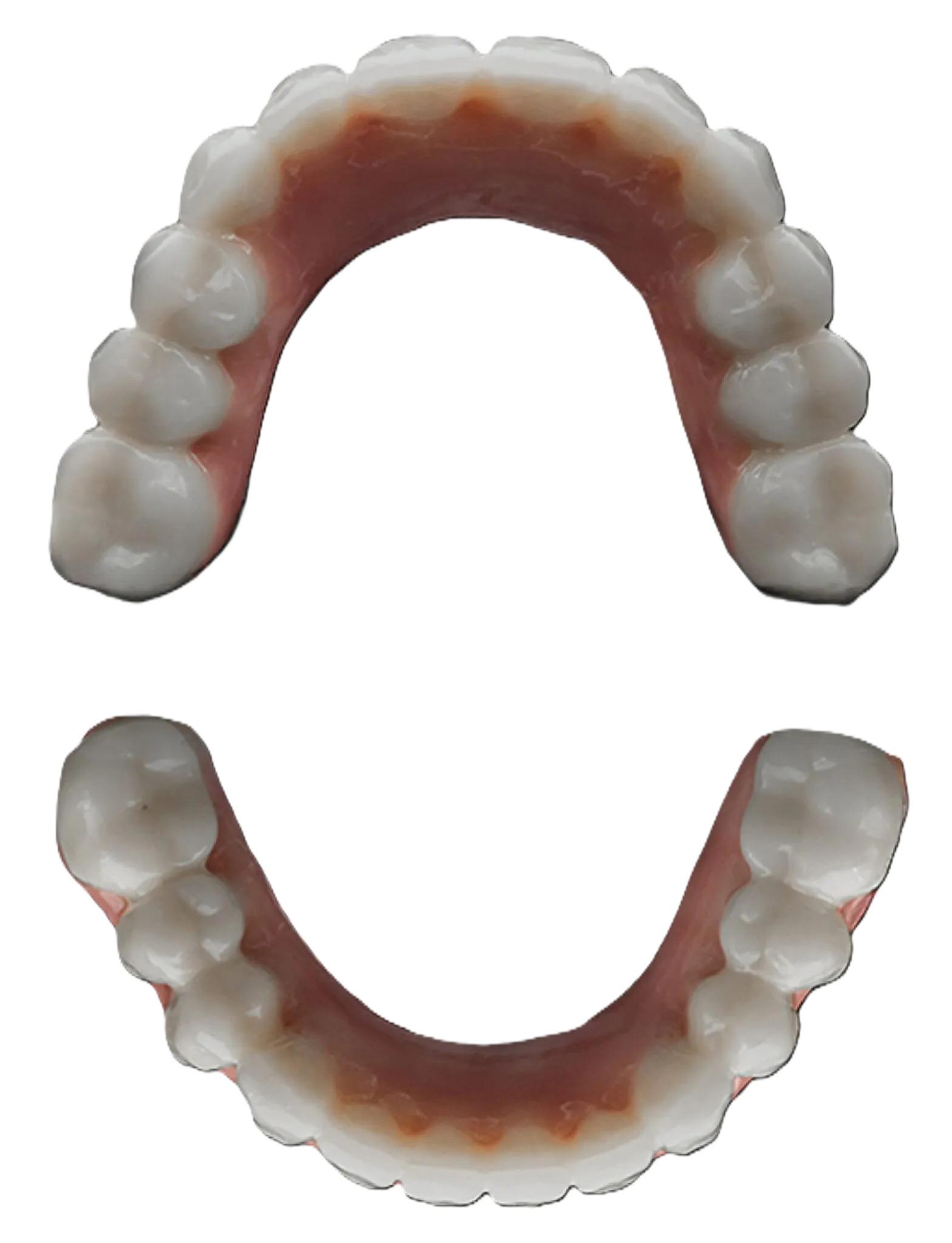 Smileloc® dental implant prosthesis with no screw holes or visible retention mechanisms